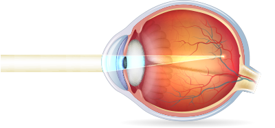 nearsightedness graphic